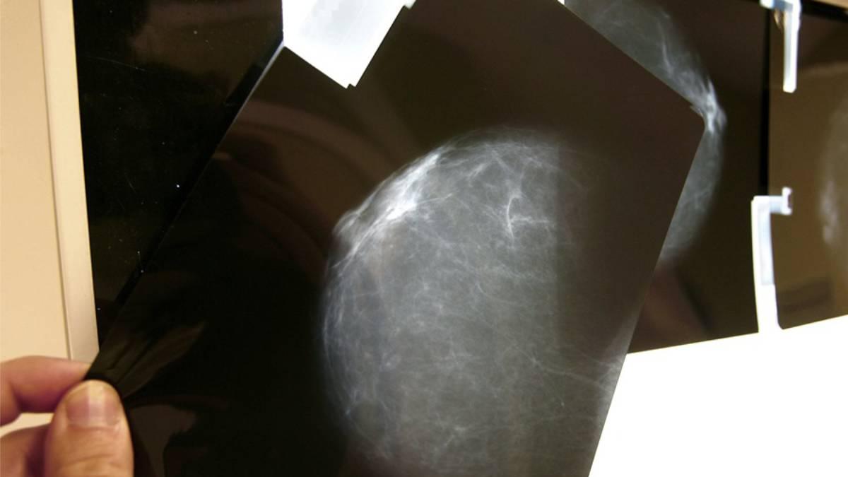 Fotografía de una prueba radiológica de mama.