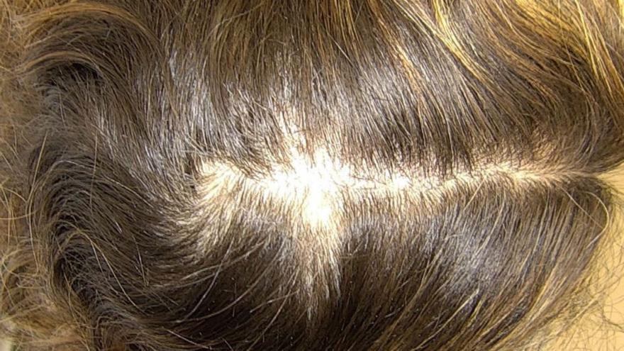 &quot;La alopecia nos hace  vivir en una constante incertidumbre&quot;