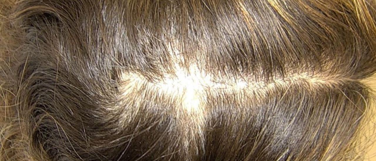 Laura muestra su cuero cabelludo antes y después del tratamiento contra la alopecia areata.  | INSTITUTO MÉDICO RICART