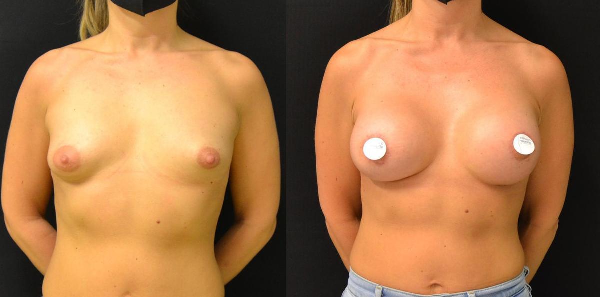 Antes y después de la operación de mama.