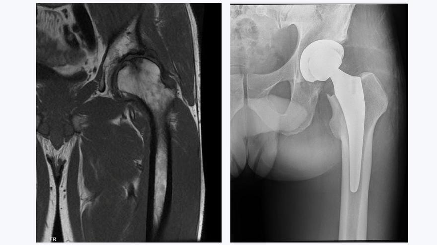 A la izq, imagen de cadera pre cirugía; a la dcha, imagen tras la cirugía.