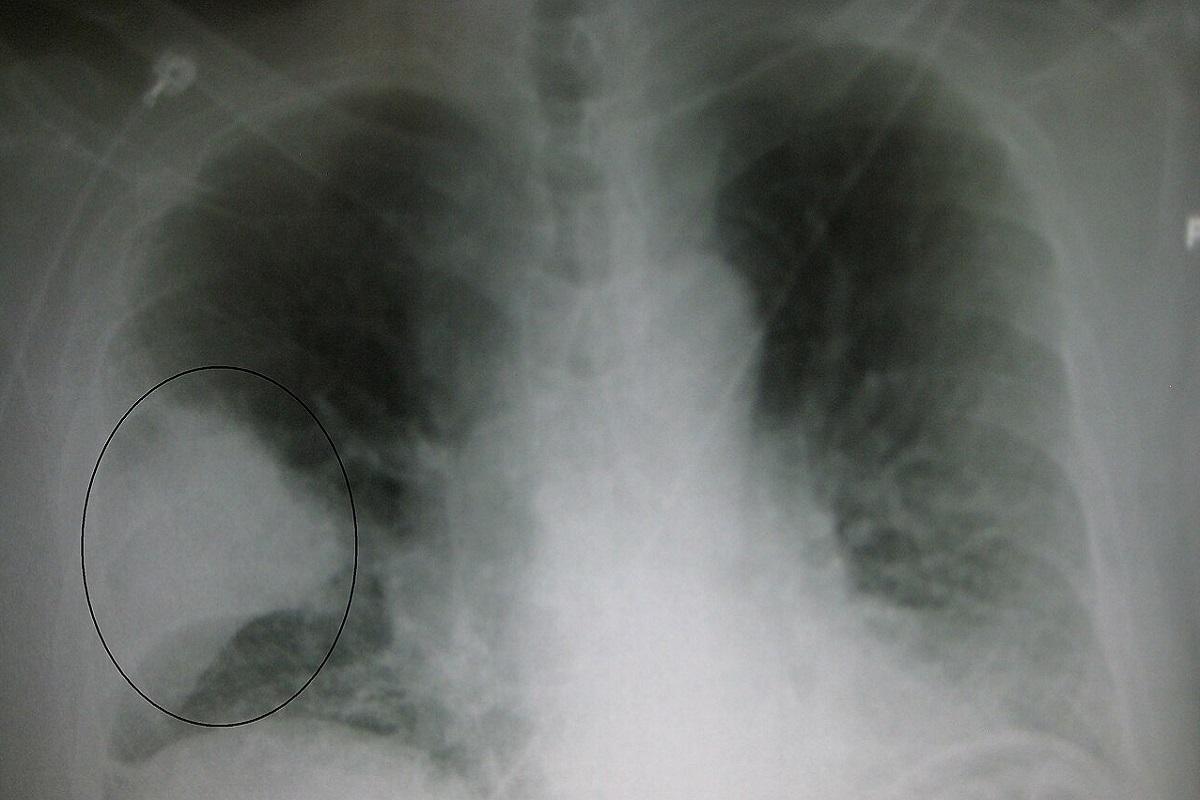 Los especialistas alertan del incremento de casos de la enfermedad neumocócica invasiva.