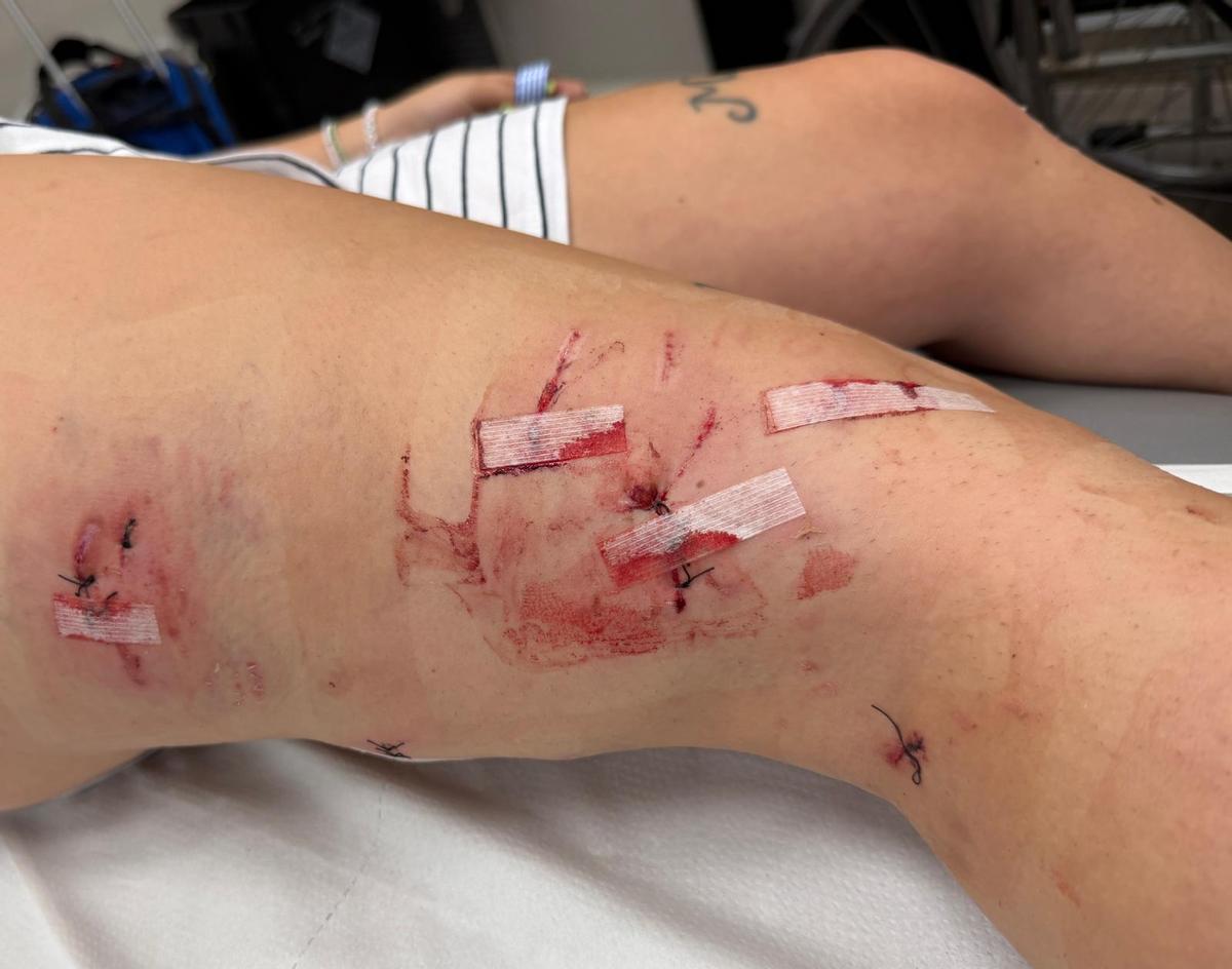 Las heridas en la pierna derecha de la joven, donde la atacó brutalmente el mastín.