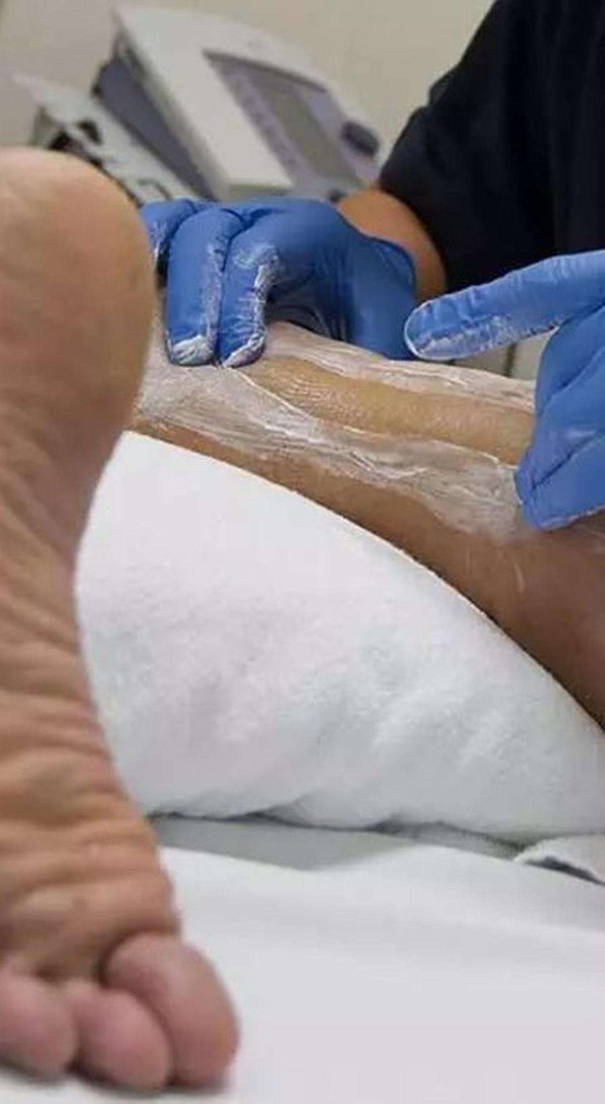 Tendó d’Aquil·les regenerat