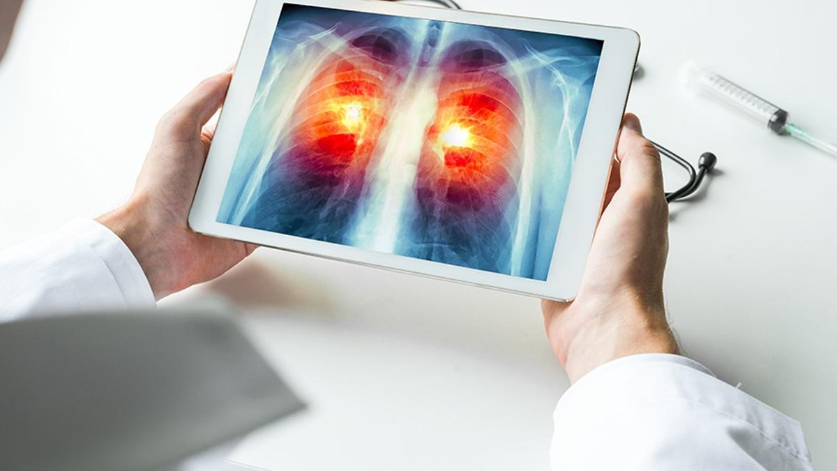 Radiografía digital acerca de un cáncer de pulmón.