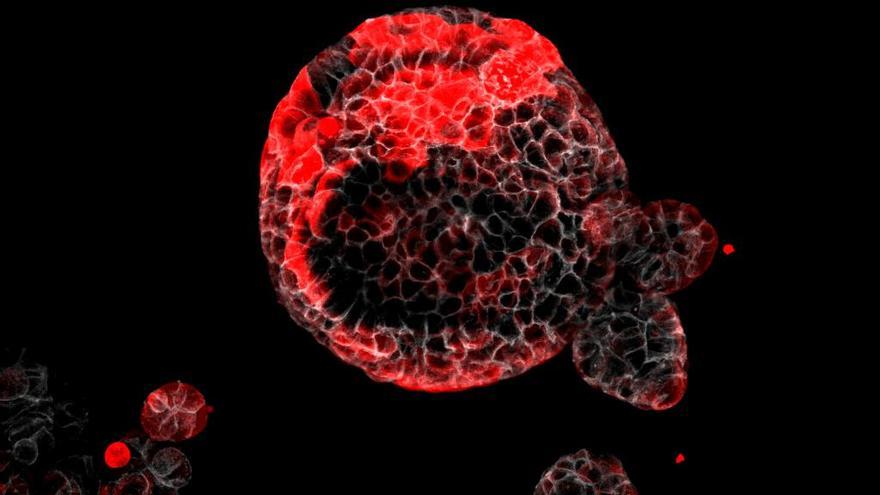 Organoide de càncer colorectal amb cèl·lules residuals responsables de la recaiguda marcades en vermell