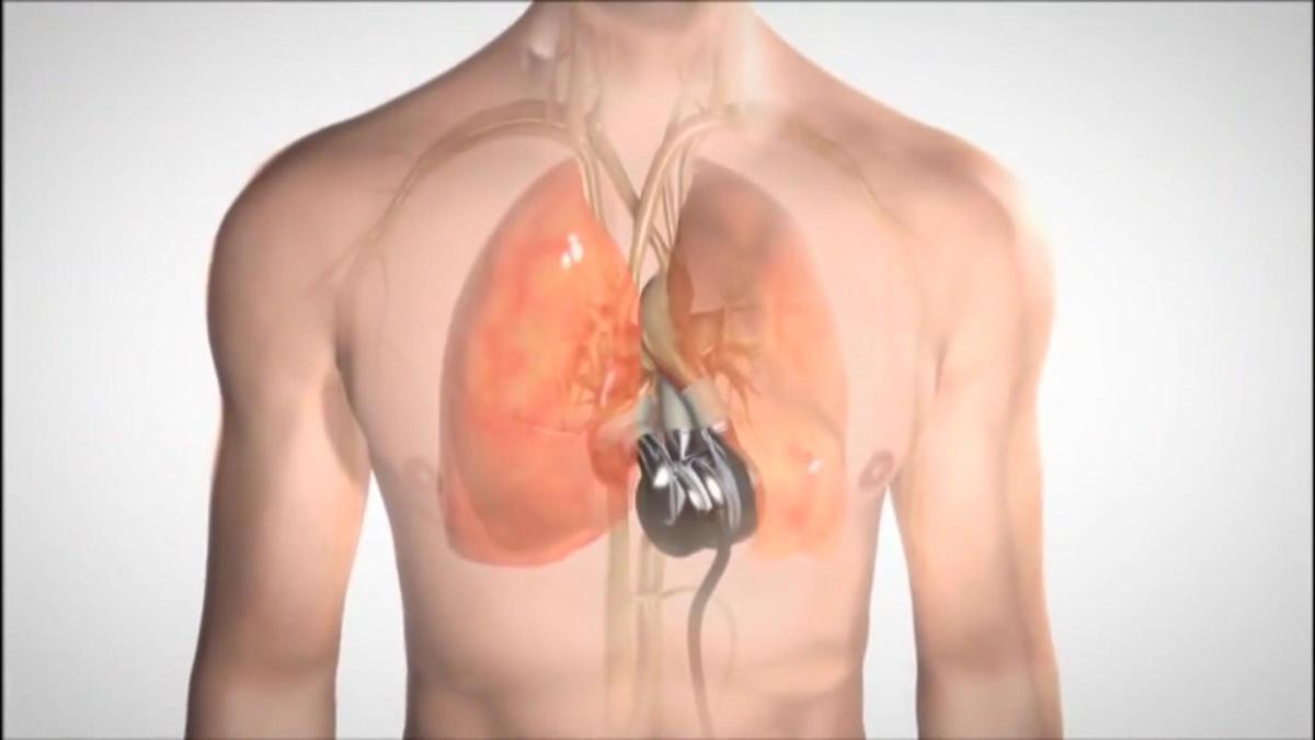 Hito médico: un hombre con insuficiencia cardíaca terminal sale del hospital con un corazón artificial total