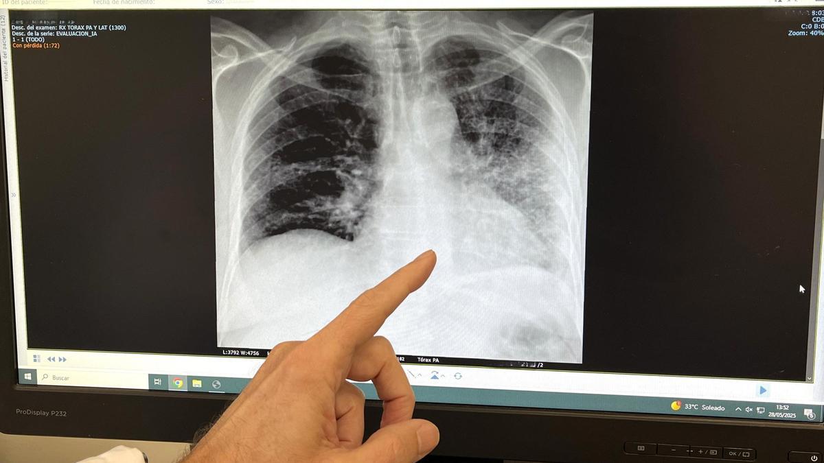 Radiografía de un paciente fumador con cáncer de pulmón