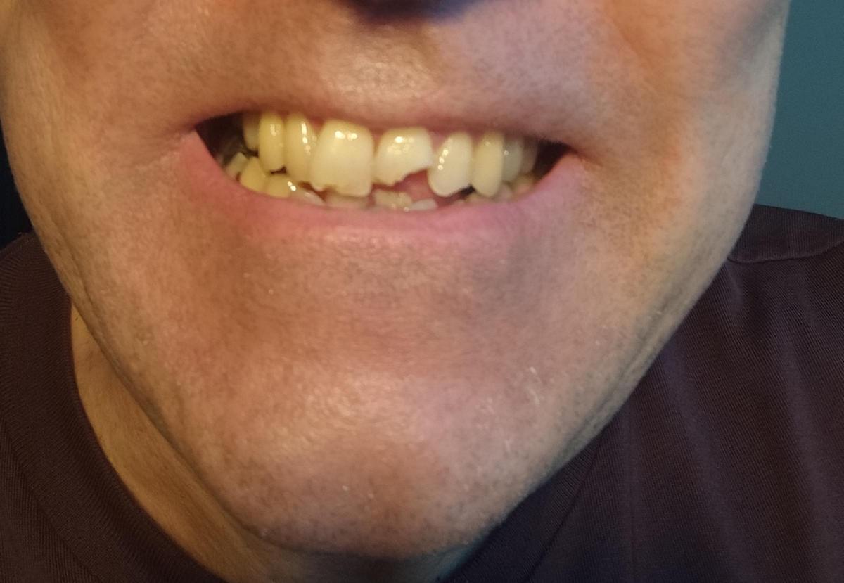 Així va quedar la dent d'aquest ciutadà després de patir una caiguda amb el Bizi.