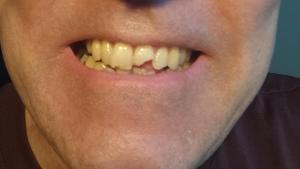 Li patina la roda d'una bici, es trenca una dent i el canell i el multen per "conduir sense la diligència necessària": "Em vaig sentir molt indefens"