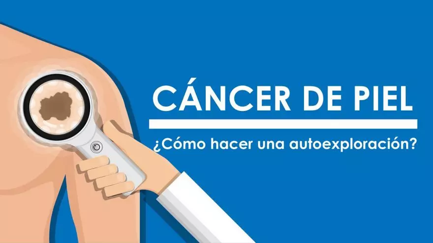 Cáncer de piel: ¿Cómo hacer una autoexploración?