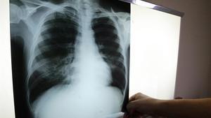 Radiografía de un enfermo de tuberculosis.