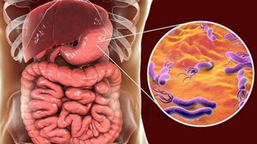 Así son los síntomas del Helicobacter pylori