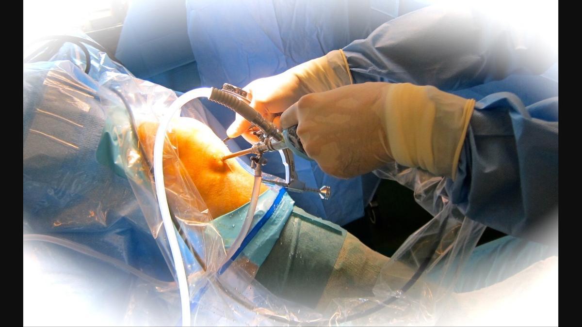 Ligamentoplastia del ligamento cruzado anterior con una nueva técnica ‘all inside’ que reproduce mejor la anatomía con mejores resultados en deportistas de alta demanda.