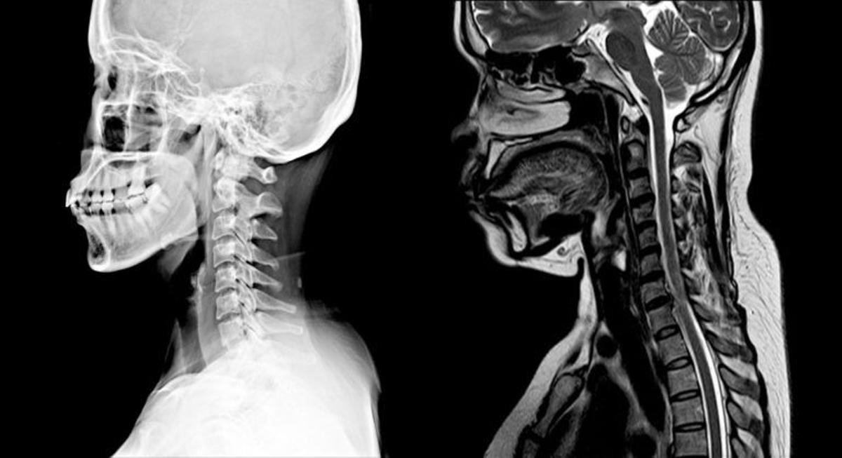 Día Mundial de la Esclerosis Múltiple: la primera causa de discapacidad entre los jóvenes de 20 a 40 años