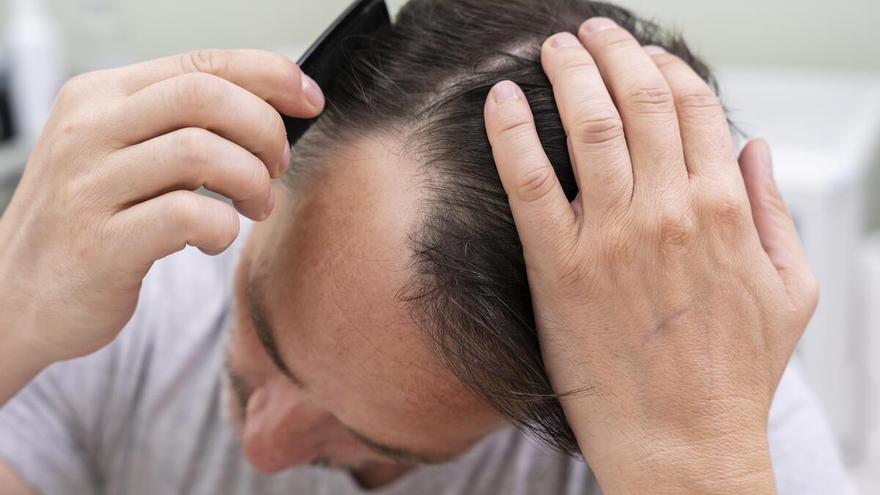 La alopecia afectará a todos los hombres a lo largo de su vida: ¿cómo frenar la caída del cabello?