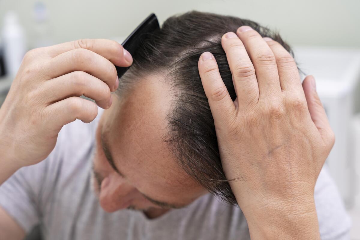La tiña del cuero cabelludo causa picor, descamación e inflamación, y en el peor de los casos, alopecia