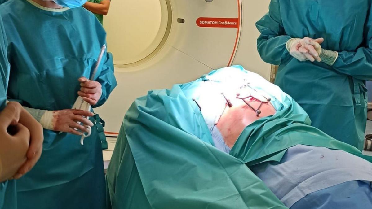 Intervención de un tumor pulmonar en el Álvaro Cunqueiro.