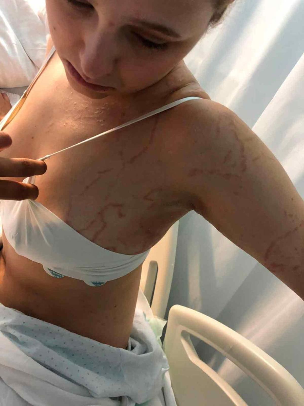 Una carabela ataca a una chica de 22 años en Calnegre: &quot;Creía que me moría&quot;