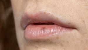 ¿Qué hacer si tengo los labios quemados? ¿Cómo cuidarlos? Responde una experta