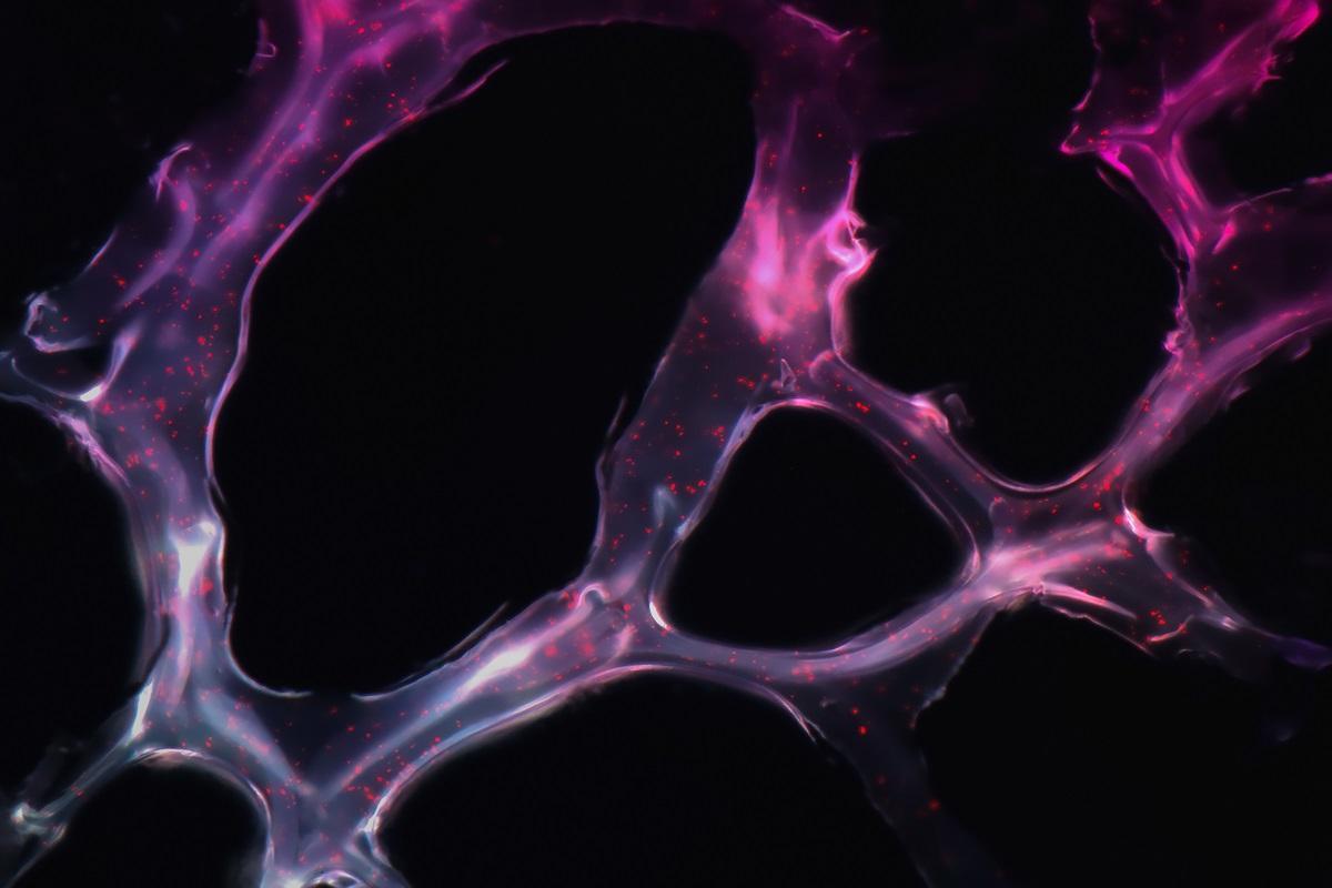 ¿Cuáles serán los cánceres más diagnosticados este año en España?