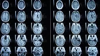 Los casos de tumores cerebrales en Málaga aumentan por quinto año consecutivo