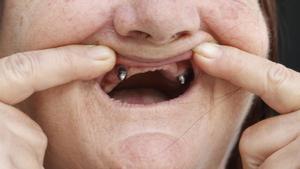 Cinc anys sense dents per l’estafa d’iDental