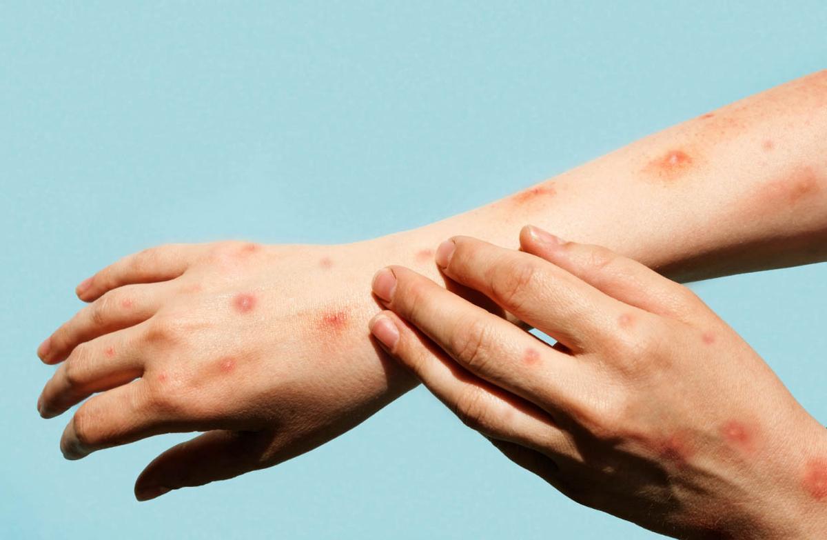 Lesiones de la viruela del mono