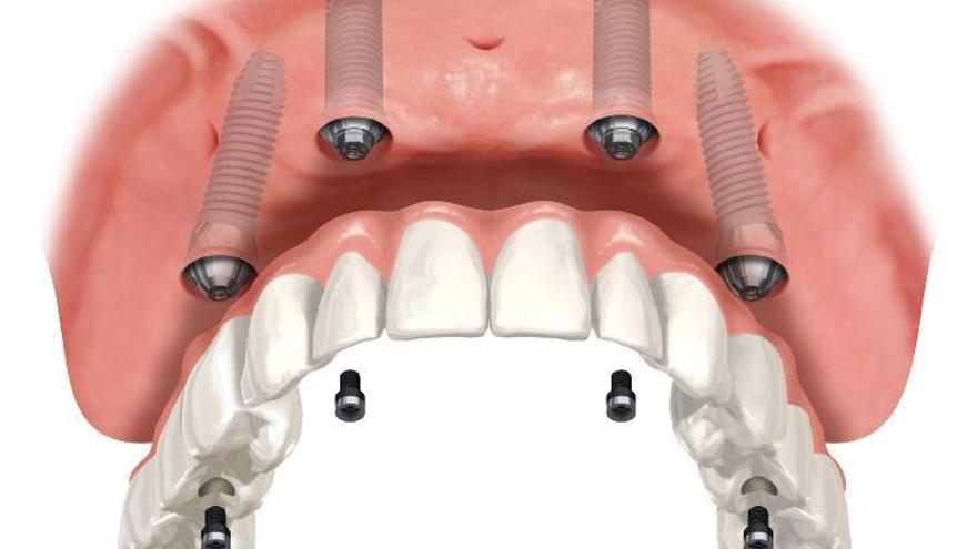 El sistema de implantes dentales ‘All on 4’ repone todas las piezas en un solo día, explican desde la clínica dental de Vigo Titanium.