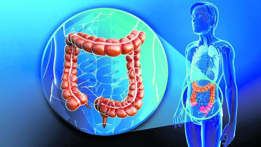 El 90% de las muertes por cáncer de colon podrían evitarse con una colonoscopia