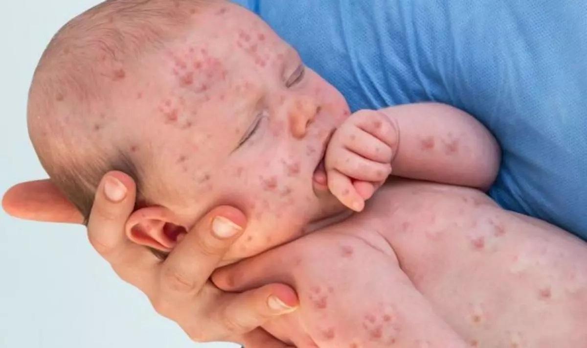 n bebé con exantema (manchas de color rojo) por sarampión