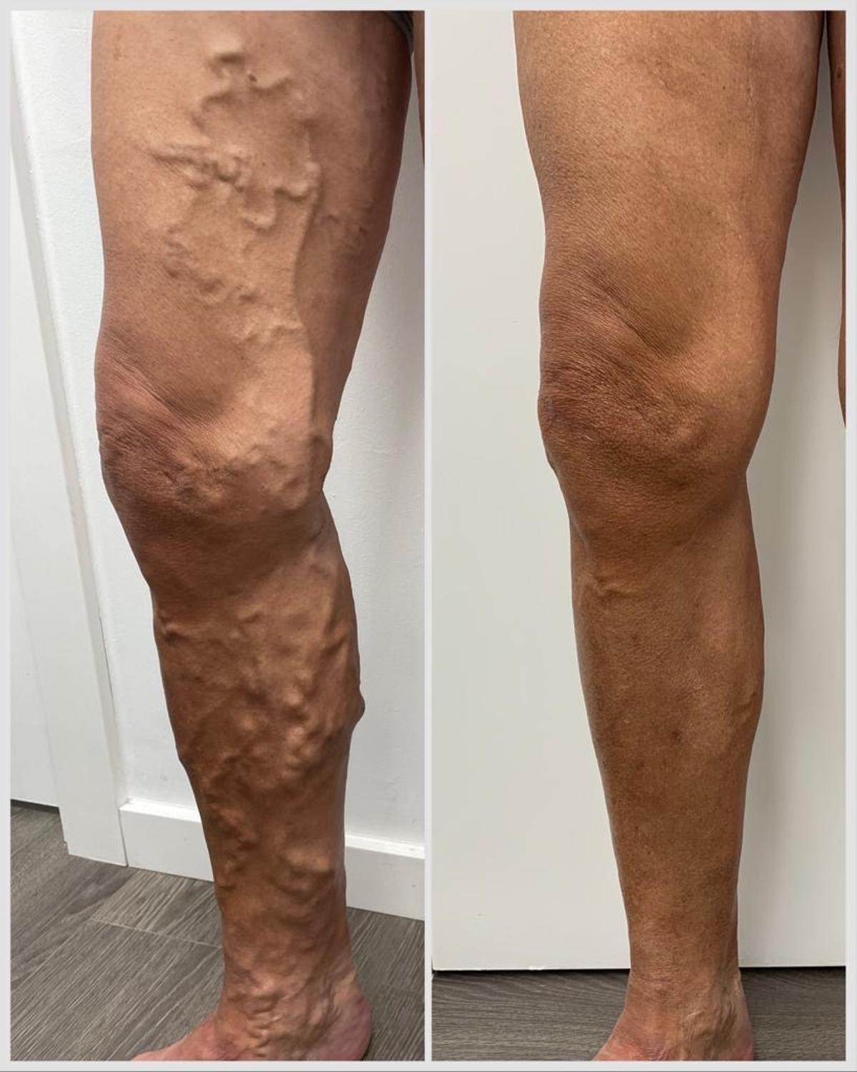 Ejemplo del antes y después de un paciente de Varitek.