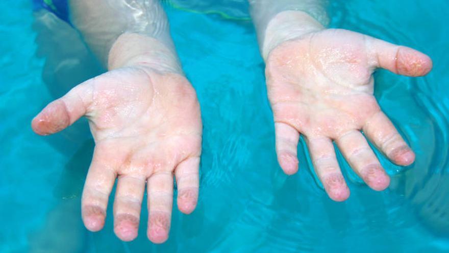 Los dedos arrugados por el agua es un fenómeno de nuestra piel.