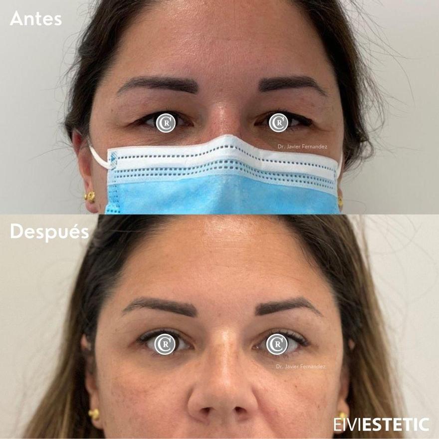 Blefaroplastia: antes y después de una paciente de Eiviestetic