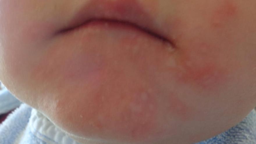 Ronchas alrededor de la boca de un niño afectado, este martes.