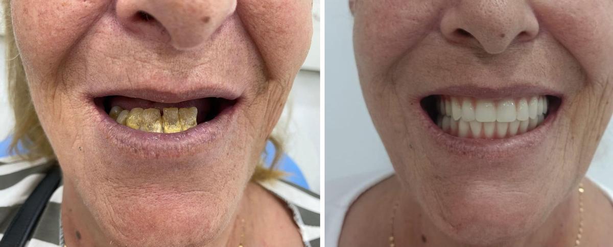 Antes y después de un tratamiento en IGB Dental.