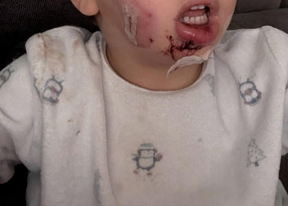 Heridas que sufrió en la cara el niño por el ataque del perro.