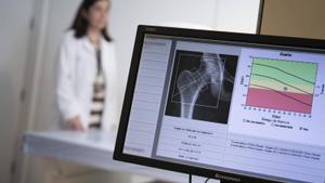 El 72% de dones amb osteoporosi no rep teràpia després d’una fractura