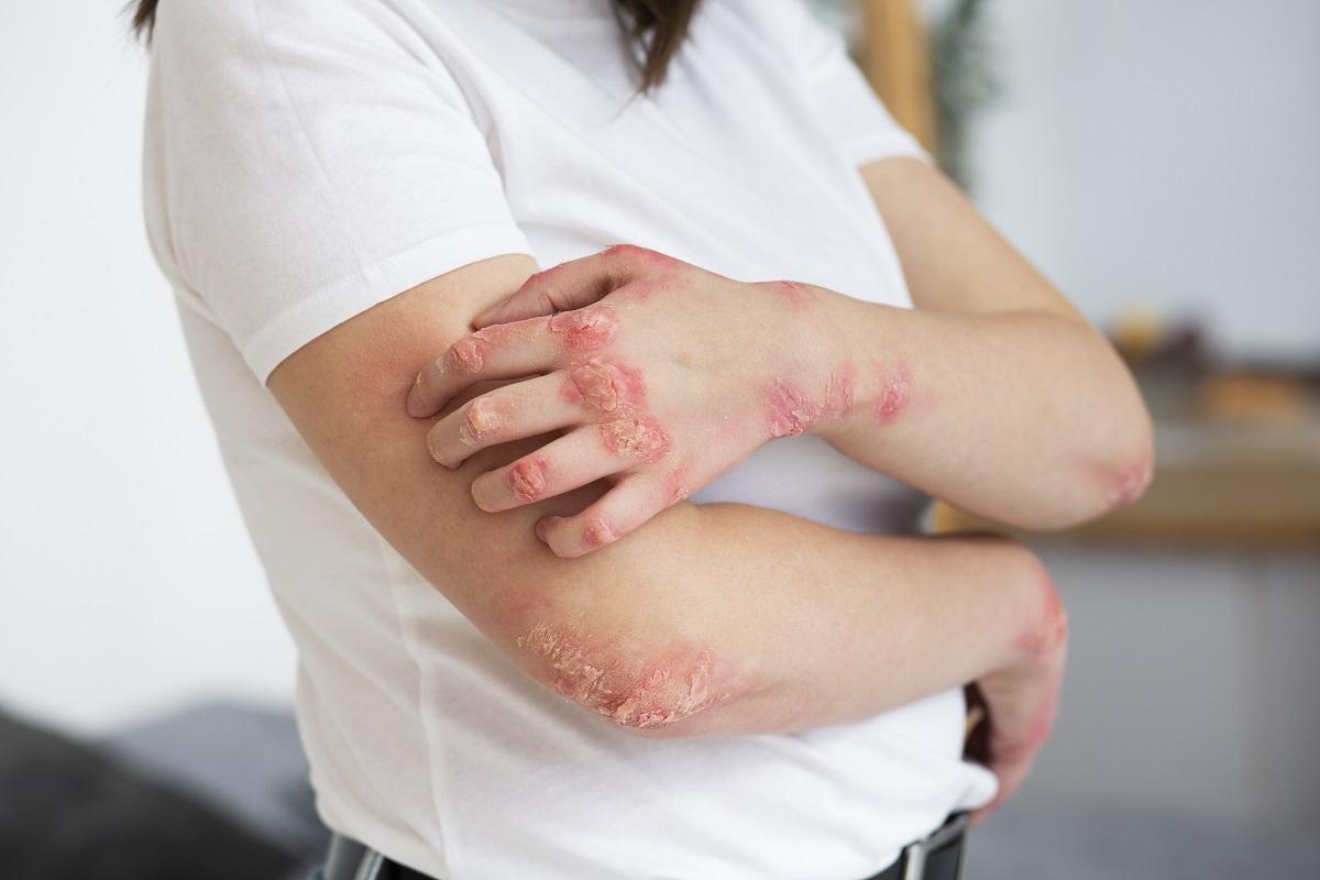 Arthritis with psoriasis is accompanied by peeling of the skin.