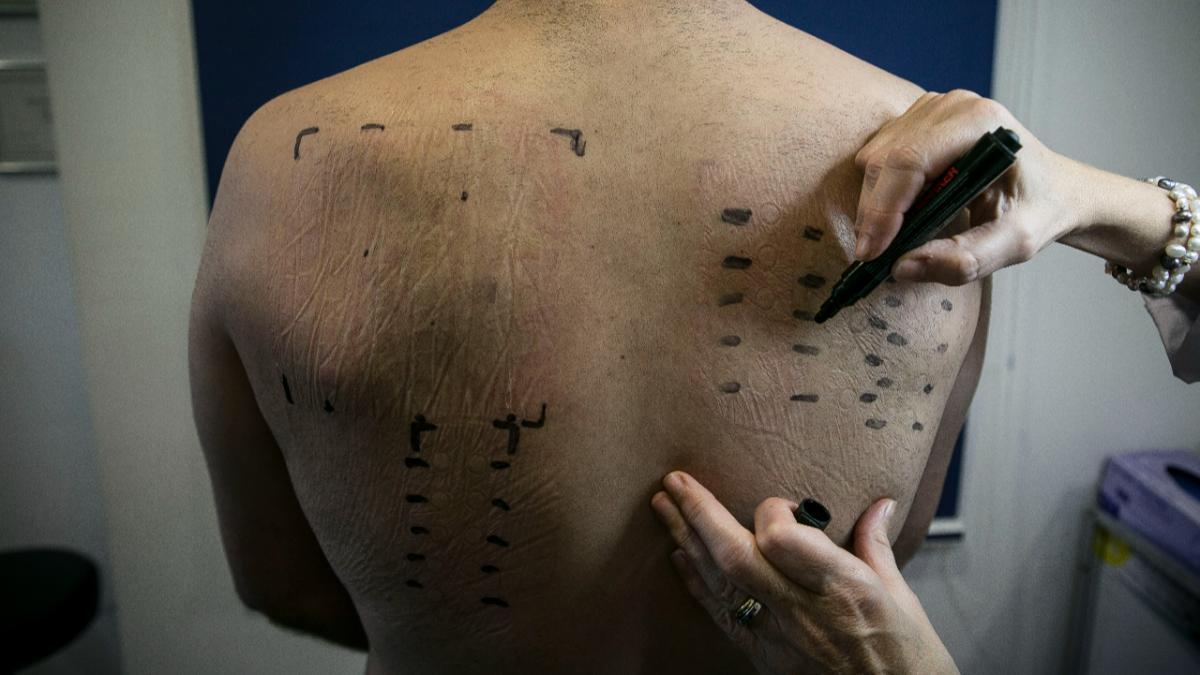 Un paciente con dermatitis en la clínica Quirón.