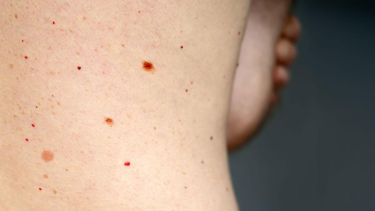 LUNAR PIEL Parece un lunar pero si tienes una mancha así en tu