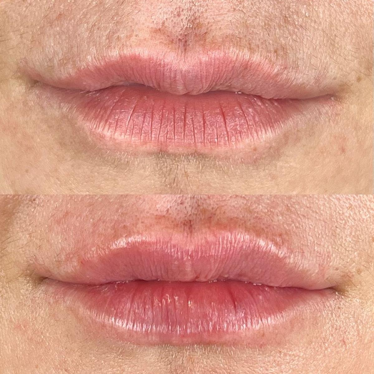 El antes y el después de un tratamiento de labios.