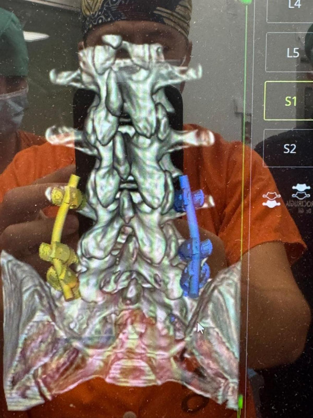 La Princesa estrena el robot neuroquirúrgico Mazor para operar cirugía compleja de columna en la sanidad pública madrileña.