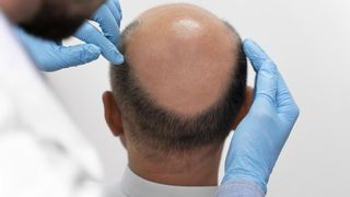 Cómo evitar la caída del pelo por alopecia androgénica, que afecta a la mitad de los hombres de 50 años