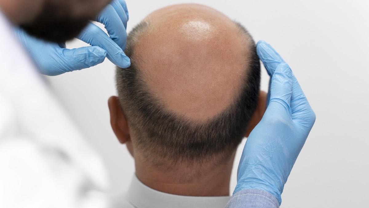 El tipo de alopecia más habitual es la androgénica.