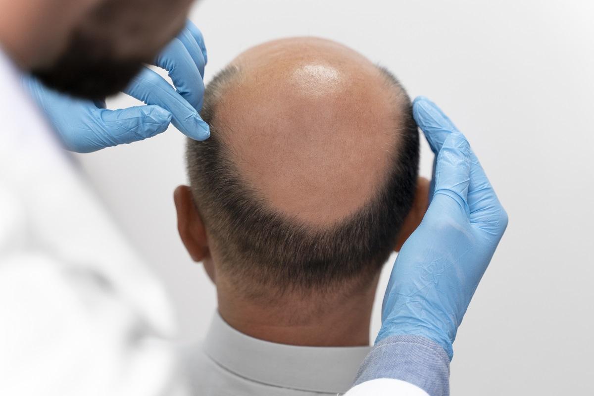 El tipo de alopecia más habitual es la androgénica.