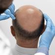 El tipo de alopecia más habitual es la androgénica.