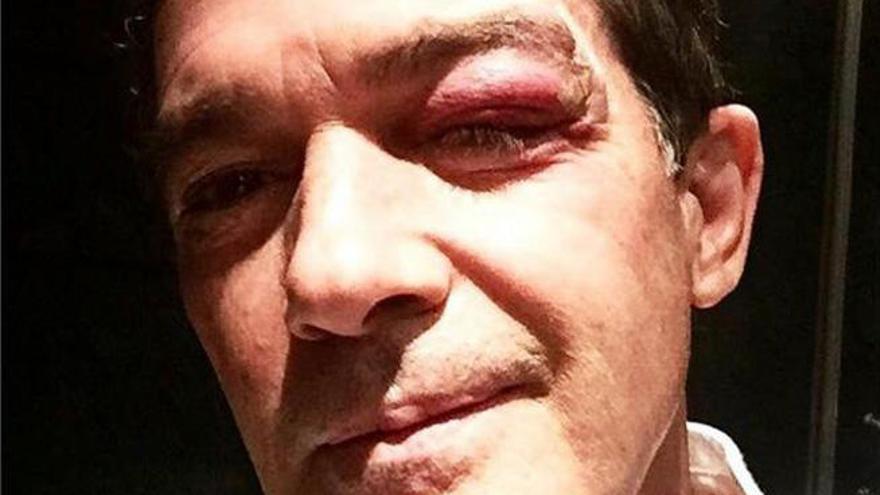 Antonio Banderas muestra su ojo malogrado.