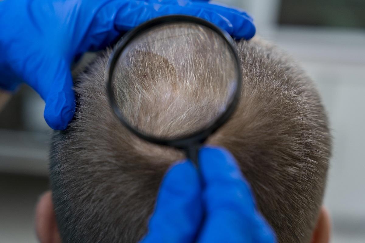 Hay más de 100 tipos de alopecia descritos.