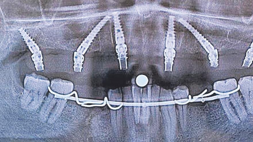 Radiografia després de la cirugia.